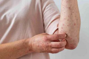 San Borja refuerza cuidado de la salud ante casos de viruela del mono